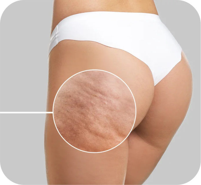 Cellulite Reduction