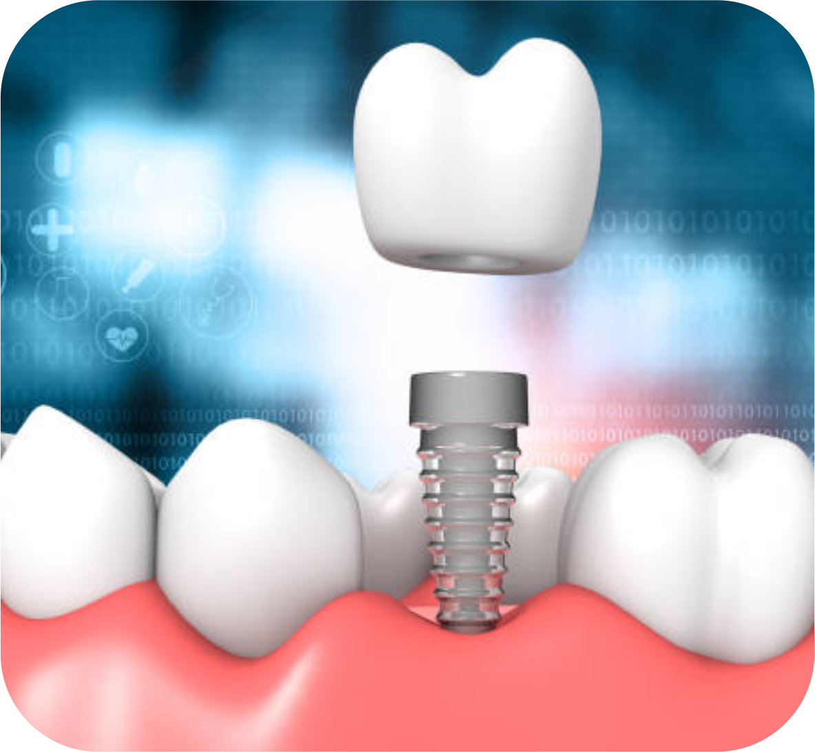 Implantology