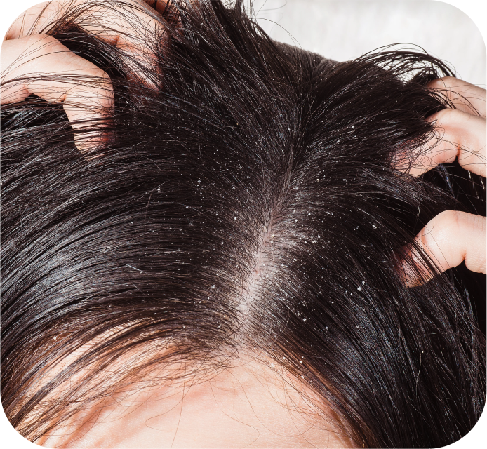 Scalp Disorders