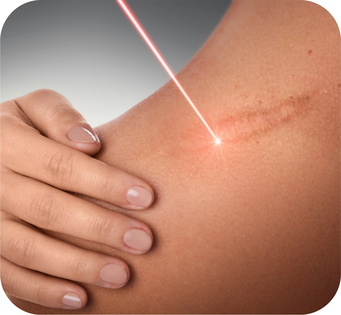 Scar Revision
